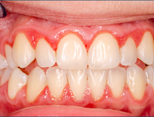 Preventing Gingivitis and Gum Disease