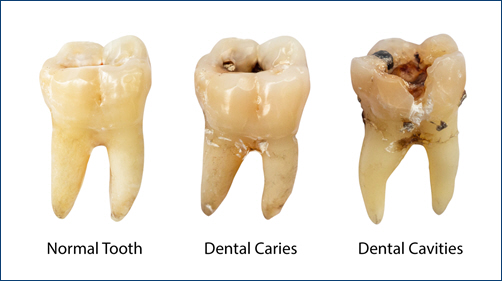 Tooth Decay