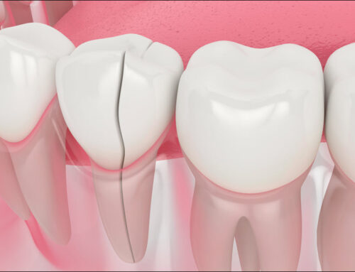 Restoring Damaged or Cracked Teeth