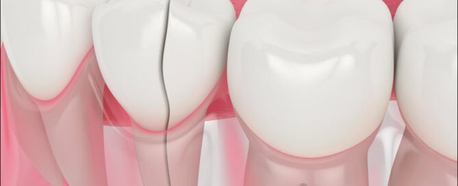 Damaged Teeth