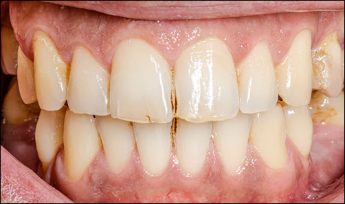 Damaged Teeth