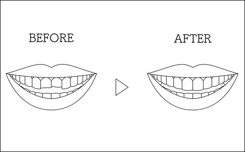 Dental Veneers