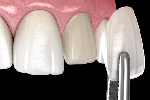 Dental Veneers