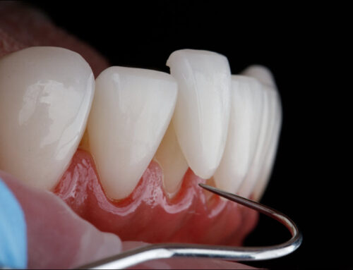 Dental Veneers and Dental Bonding: Enhancing Your Smile