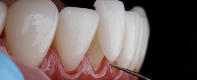 Dental Veneers