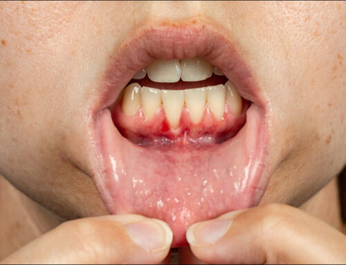 Treating Receding Gums