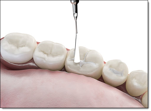 Filling Restorations