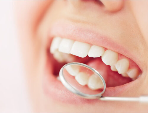 How Long Do Dental Restorations Last?