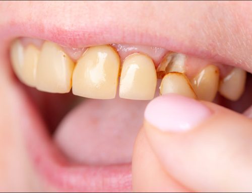 Restoring and Protecting Damaged Teeth