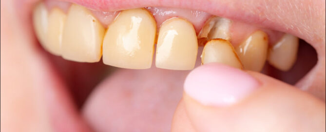 Damaged Teeth