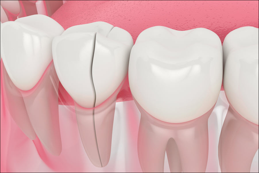 Damaged Teeth