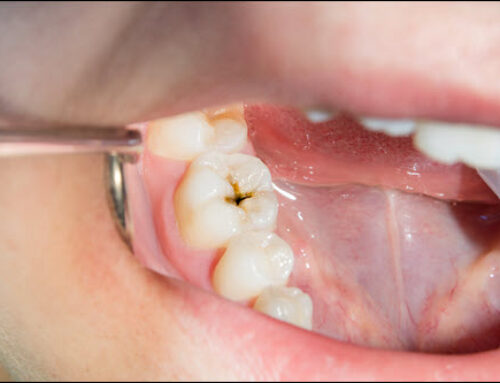 The Stages of Tooth Decay and How to Prevent It