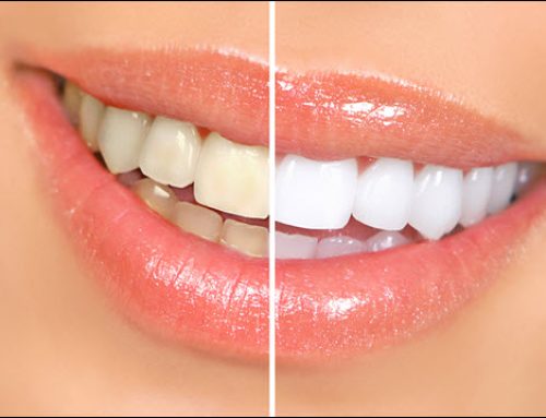 Teeth Whitening Options: Professional Whitening Outshines At-Home Methods