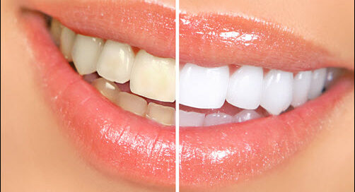Whitening