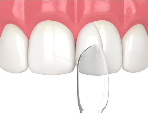 Dental Bonding: A Simple Way to Improve Your Smile