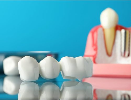 Dental Bridges: A Reliable Solution for Missing Teeth