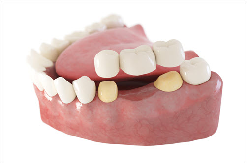 Dental Bridges